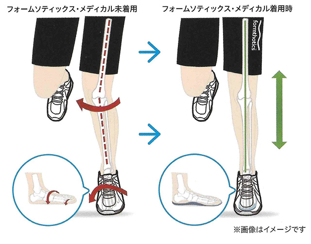 フォームソティックス・メディカル着用時のイメージ