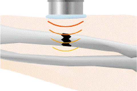 超音波、骨折治療（ULTRASOUND770/LIPUS）